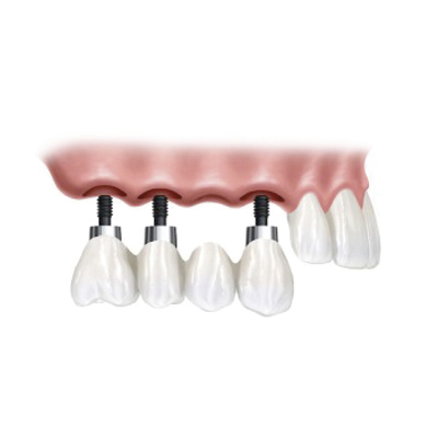 implants-protesi-fixa Implants protesi fixa