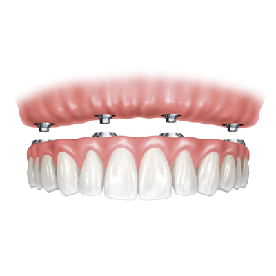implants-seccio-protesi-fixa1 Implants seccio protesi fixa1
